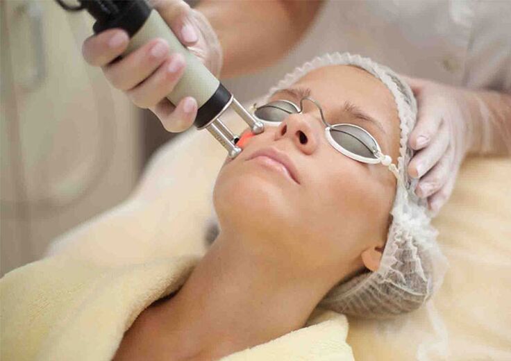 Procedimento de rejuvenescimento da pele a laser ao redor dos olhos