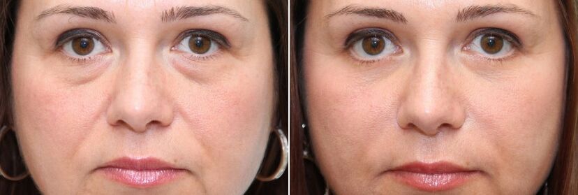 Antes e depois da blefaroplastia - remoção do corpo gorduroso sob os olhos e endurecimento da pele