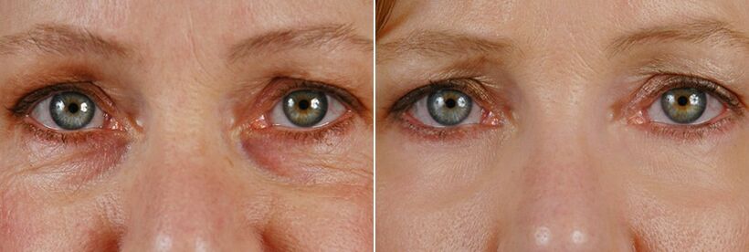 Antes e depois da cirurgia a laser - rejuvenescimento da pele ao redor dos olhos