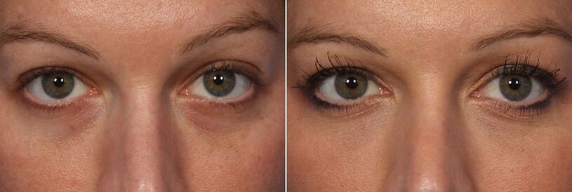Antes e depois do uso de preenchedores injetáveis ​​- redução de olheiras